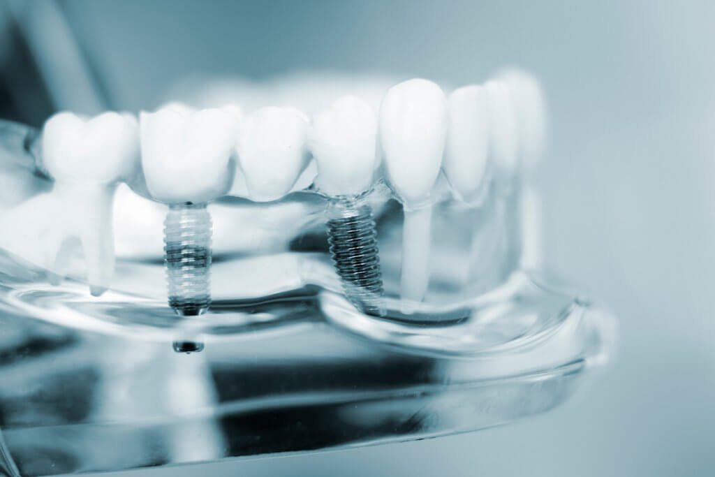 How Much Do Dental Implants Cost In Middlesex County Ma